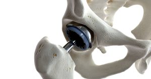 3d rendered medically accurate illustration of a hip replacement; blog: recovering from total hip replacement