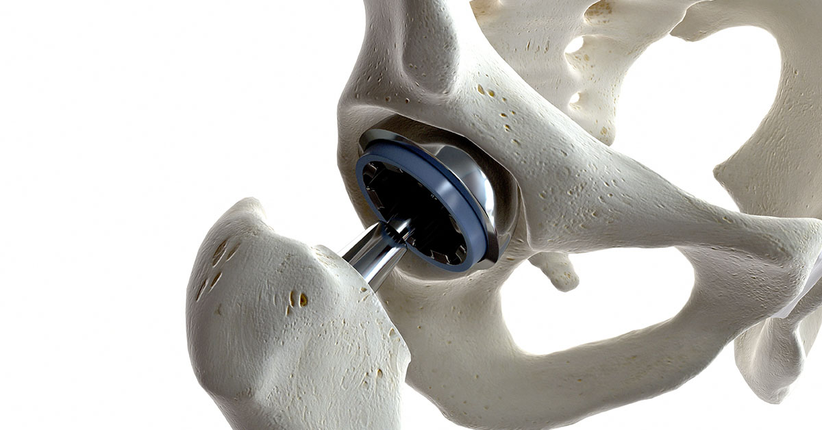 Tips for Recovering from Total Hip Replacement - South Shore Orthopedics