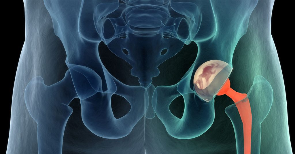 Medically accurate illustration of the hip replacement. 3d illustration; blog: What is Direct Anterior Hip Replacement?