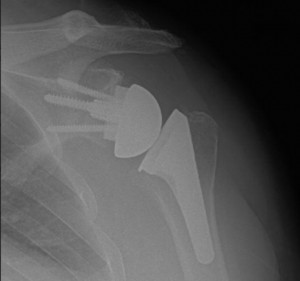 Reverse Shoulder Replacement