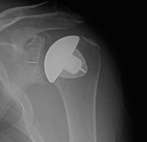 total shoulder replacement